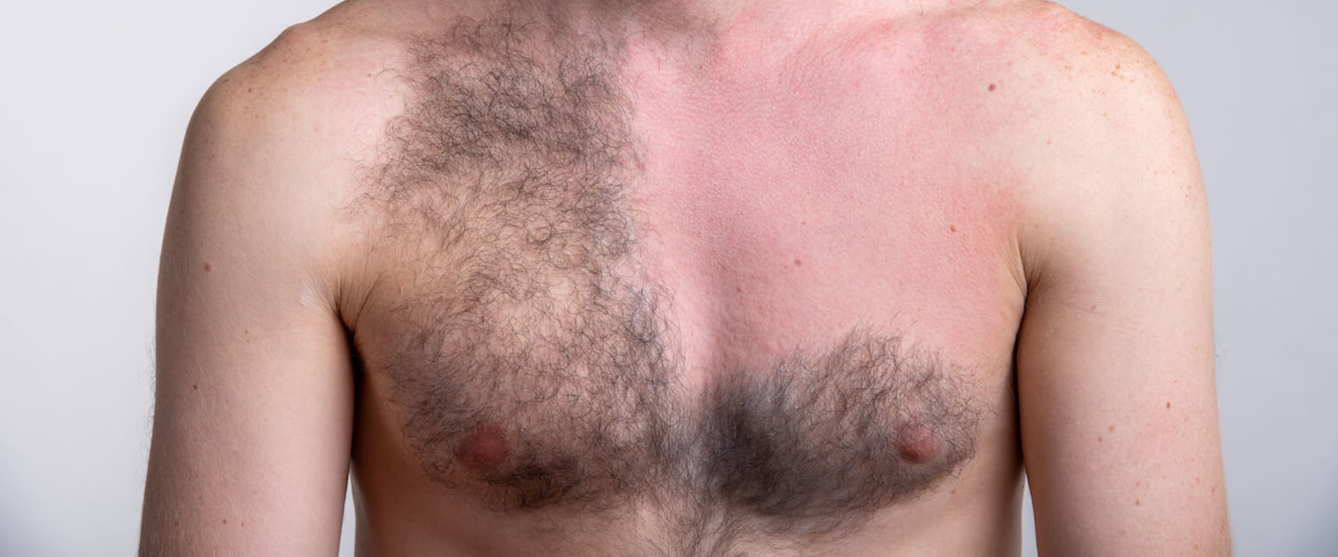 Understanding the Changes in Pigmentation After Laser Hair Removal