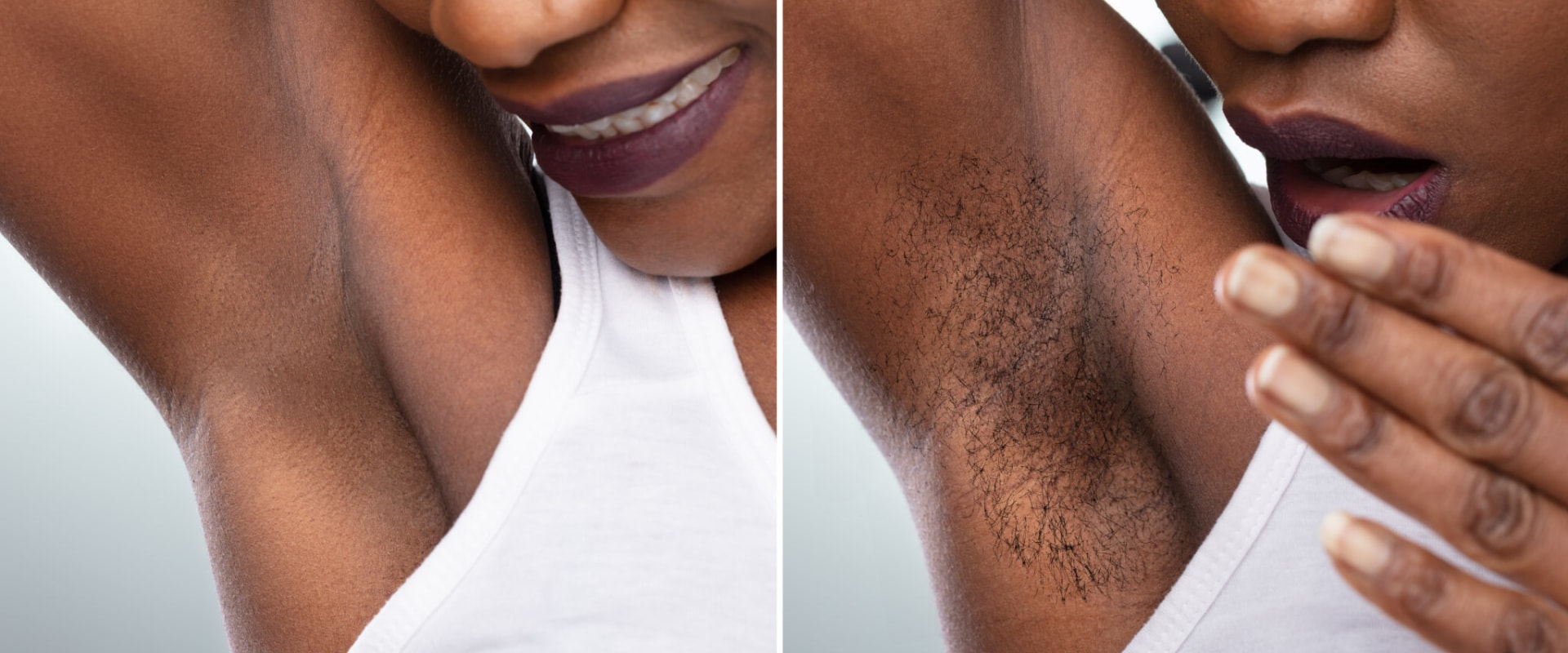 The Benefits of Laser Hair Removal on Dark Skinned Patients