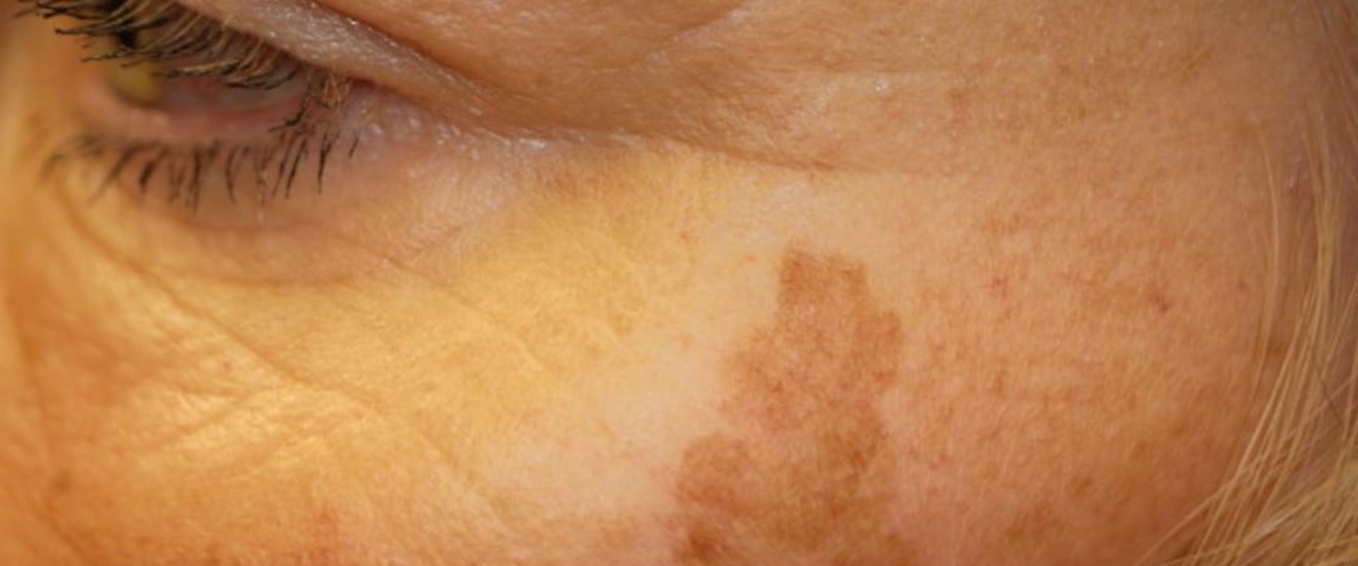 Pigmentation Changes in the Skin: Causes and Treatments