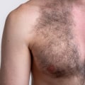 Understanding the Changes in Pigmentation After Laser Hair Removal