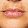 Pigmentation Changes in the Skin: A Comprehensive Overview