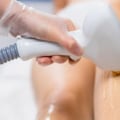 The Average Cost of Laser Hair Removal by Session