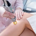 The Financial Risks of Laser Hair Removal