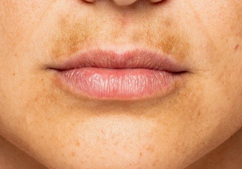 Pigmentation Changes in the Skin: A Comprehensive Overview