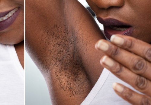 The Benefits of Laser Hair Removal on Dark Skinned Patients