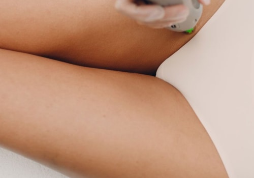 Reduced chance of ingrown hairs: Benefits of Laser Hair Removal