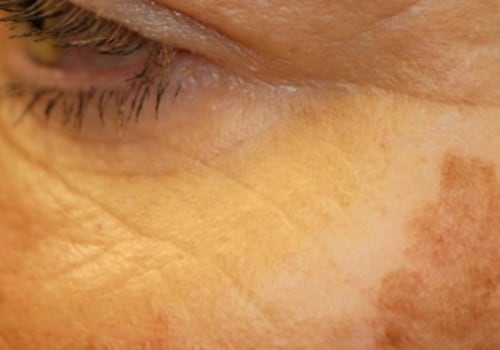 Pigmentation Changes in the Skin: Causes and Treatments