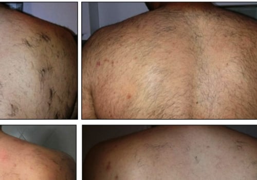 Laser Hair Removal Treatments: Exploring Nd:YAG Lasers